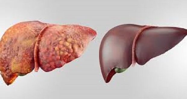 تاثیر داروهای کاهش وزن در مقابله با بیماری کبد چرب