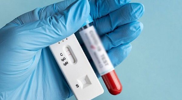 فناوری تولید کیت‌های تشخیص HIV توسعه می‌یابد