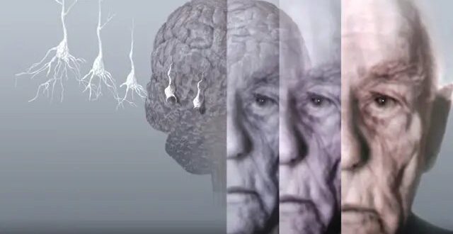 رمزگشایی از تفاوت‌های جنسیتی در ابتلا به زوال عقل